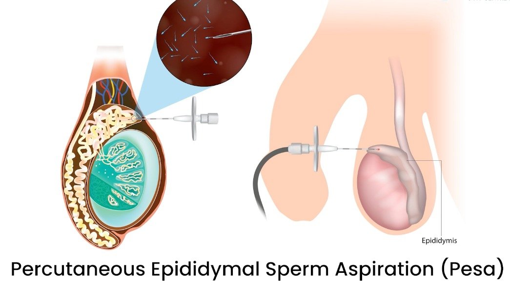 Testicular Sperm Aspiration (TESA)